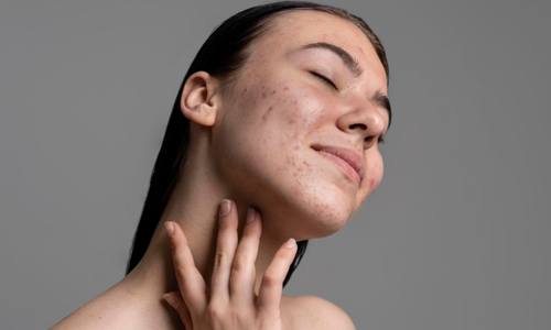 vita clinic - Tratamento para acnes